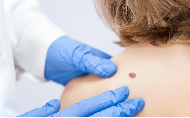 Excision of Skin Lesions